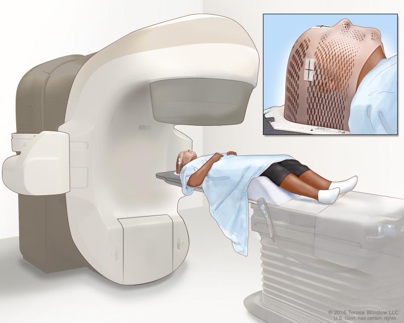 12 di 20 28/06/2016 11.18 Radiation therapy is a cancer treatment that uses high-energy x-rays or other types of radiation to kill cancer cells or keep them from growing.