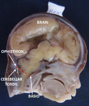 Rapotra Megha et al / Arnold Chiari Malformation - A hospital based autopsy study 252 Table 2: Other related clinical findings associated with Arnold Chiari