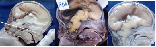 No Associated Anomalies No Neural Tube Defects Hydrocephalus 2 A Corpus Callosum Hypoplasia 1 (Spina Bifida) Thoraco-Lumbar Region 10 Club foot 3 B Musculoskeletal