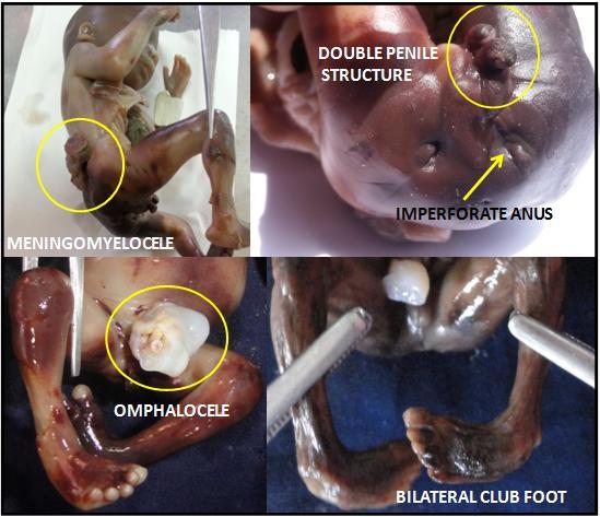 Rapotra Megha et al / Arnold Chiari Malformation - A hospital based autopsy study 253 Figure 3: Showing Arnold Chiari Malformation as part of OEIS complex 4.