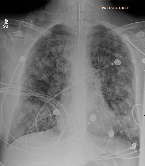 Current Medical History Mar 2, 2016: Acute worsening of SOB, hypoxemia; FEV 1 dropped to 0.