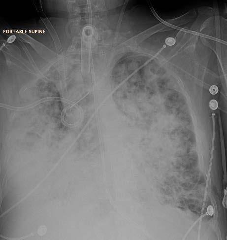 RIJ and 25 Fr RF Tracheostomy After ECMO insertion