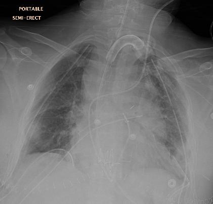 Bilateral Lung Transplant April 22, 2016 (5 days after pneumonectomy) On central VA-ECMO Left side implantation first ( CIT: 3h 15 min, WIT: 49 min) Removed the PA cannula from right PA