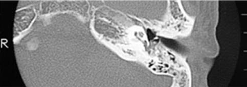 The Journal of International Advanced Otology Computed tomography did not reveal osseous defect but soft tissue lesions in the labyrinth (Fig. 1a, 1b).