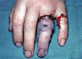 2. A 29-year-old man sustained a ring