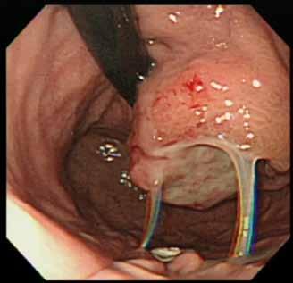 Endoscopic ultrasound (EUS) was performed, which revealed a hypoechoic mass arising from the muscularis propria of the stomach wall. The patient then underwent an EUS-guided trucut biopsy.