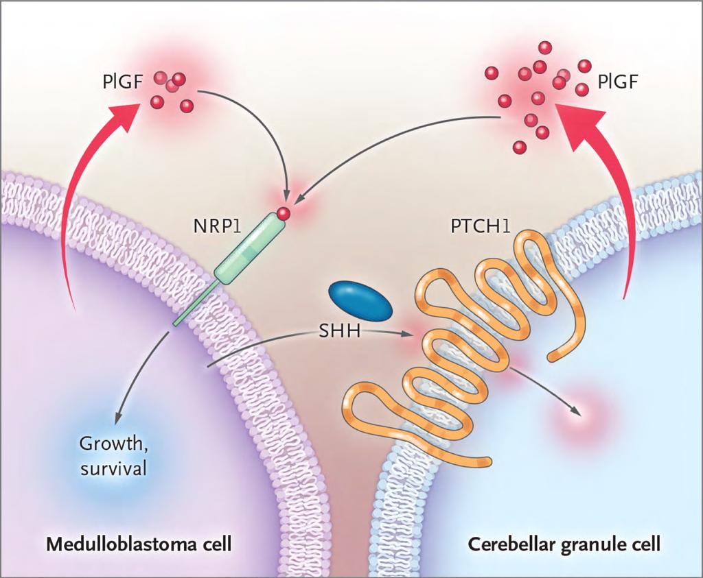 PlGF/NRP1 in Medulloblastoma