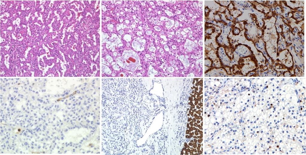 Minmi et l. Surgil Cse Reports (2017) 3:66 Pge 4 of 5 d e f Fig. 4 Histologil findings of tumors.