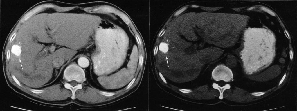 Effect of Previous Serial CT Review on Viable Tumor Depiction of Hepatocellular Carcinoma after Transarterial Chemoembolization tion.