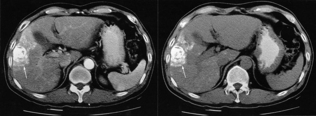 On the basis of this feature, the two observers changed their confidence level to probably viable tumor. The pathology revealed a 70% necrotic hepatocellular carcinoma.