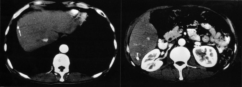 The unenhanced CT images show two compact iodized oil-containing nodules at S8 (arrow) and S6 (arrowhead) of the liver.