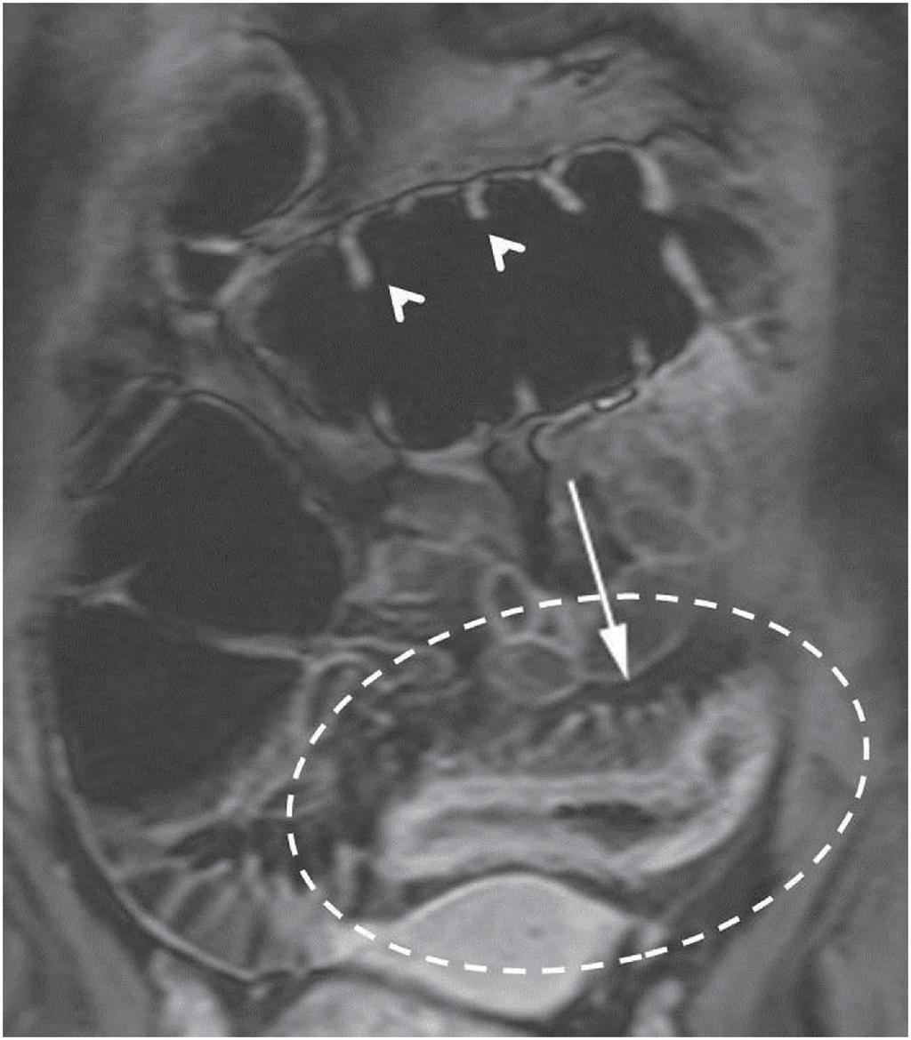 This is consistent with moderte to severe disese. Arrow, engorged vs rect; rrowhed, norml colonic hustr; U, uterus. Figure 17. Sixteen-yer-old mle with right lower qudrnt pin.