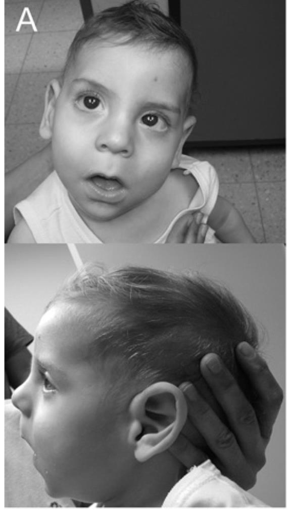 Multiple congenital anomalies-hypotoniaseizures syndrome 1 (OMIM#614080) Described a Autosomal recessive syndrome: Developmental delay Dysmorphic features Multiple congenital anomalies