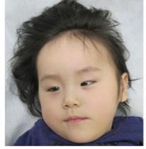 Ohba et al (2014) Two Japanese Siblings Developmental delay Hypotonia Seizures Nystagmus