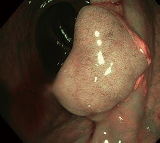 In the latter study, high definition NBI detected significantly more flat and right sided lesions compared to standard definition colonoscopy but a similar number compared to high definition