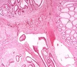 Epithelial misplacement in adenomas 85% in sigmoid colon unusual in rectum (unless