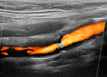 Imaging Recommendation Class Level Duplex ultrasound (as first-line), CT and/or MR angiography are recommended