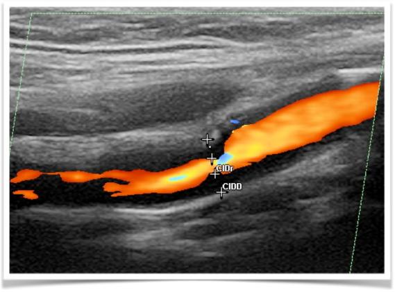 recommended that Duplex ultrasound stenosis estimation be corroborated by angio CT/MR angio, or by a repeat