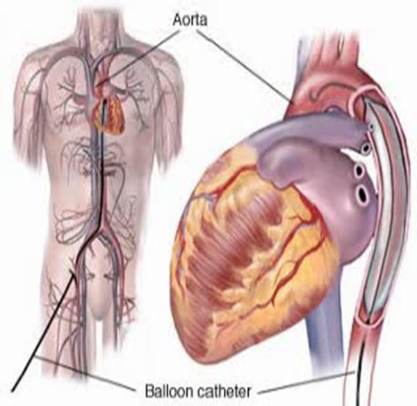 Intra-Aortic Balloon Pump Inflatable 32-40 cc balloon Triggered to inflate with helium