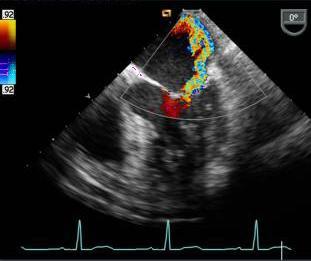 Patient With Acute Mitral Insufficiency and Cardiogenic Shock LV = 100/22 mmhg Ao = 100/65/80 mmhg PCWP = a= 25; v=