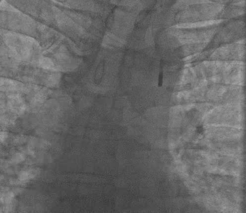 The tip of the catheter should be placed at the take of left subclavian artery, i.e. between left main bronchus and aortic knob i.e. between 2 nd and 3 rd rib What is the Correct Position of the IABP Catheter?