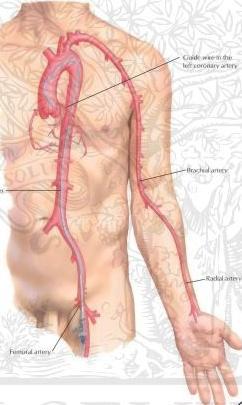 Non Femoral Access Brachial artery