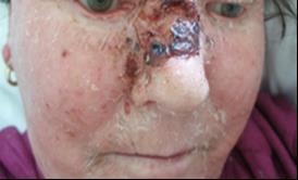 Slika 8. Nodularni BCC Preuzeto: ljubaznošću dr. sc. Marije Buljan, dr. med. Slika 9. Ulcerozni BCC (ulcus rodens) Preuzeto: ljubaznošću dr. sc. Marije Buljan, dr. med. Sklerozirajući oblik bazocelularnog karcinoma obično se pojavljuje u predjelu nosa i obraza, kao i na čelu.