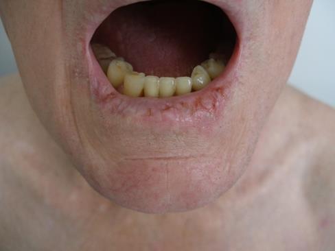 SCC na usnicama se može razviti iz leukoplakije ili aktiničkog heilitisa. U 90% slučajeva SCC se razvije na donjem rubu usnice (slika 14). Slika 14.