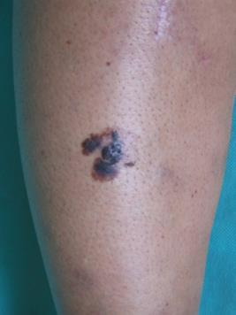 5.5.1. Površinsko šireći melanom (engl. superficial spreading melanoma SSM) Površinsko šireći melanom najčešći je oblik melanoma u bjelačkoj populaciji i čini 60-70% svih melanoma.