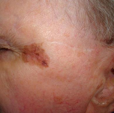 Slika 17. Lentigo maligni melanom Preuzeto: ljubaznošću dr. sc. Marije Buljan, dr. med. 5.5.4. Akrolentiginozni melanom (ALM) Akrolentiginozni melanom je najrjeđi oblik i obuhvaća 2-8% svih melanoma.