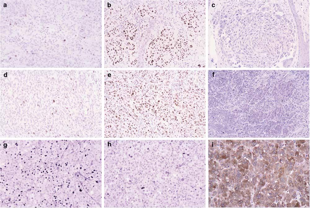Atypical Spitz nevi/tumors 202 Figure 2 (a), (d), (g) Ki-67 immunoreactivity; (b), (e), (h) p21 expression; and (c), (f), (i) fatty acid synthase expression in typical Spitz nevus, atypical pediatric