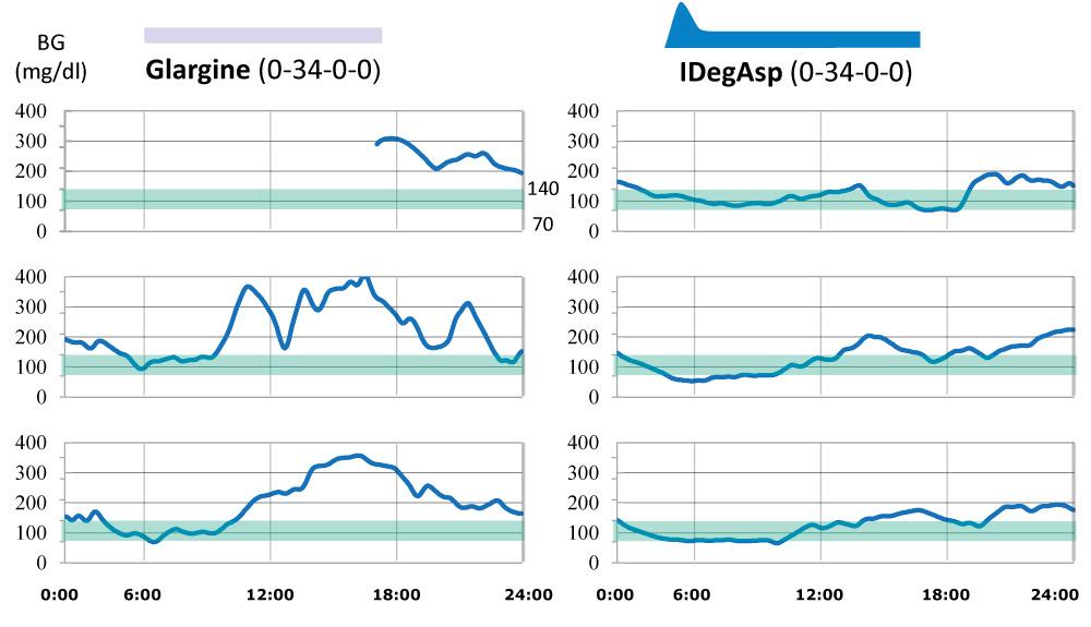 IDegAsp provides simple intensification Case Report blood glucose fluctuation was completely same as before and after changing (FIGURE 3).