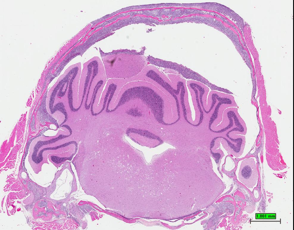 extensive AML infiltration in parenchyma and meninges