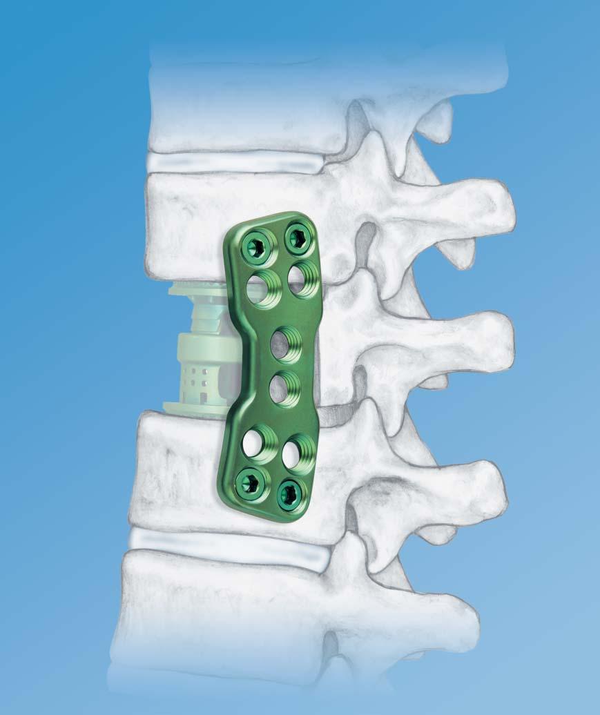 Thoracolumbar Spine Locking Plate (TSLP) System.