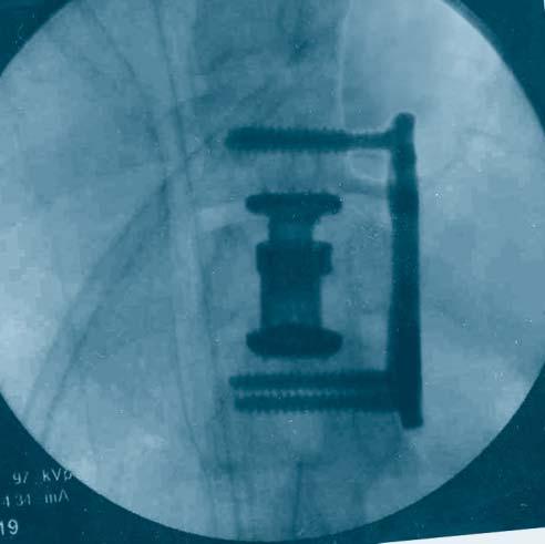 Thoracolumbar Spine Locking Plate (TSLP) System The Thoracolumbar Spine Locking Plate (TSLP) is a versatile, low-profile plating system indicated for anterior stabilization of the thoracic and lumbar