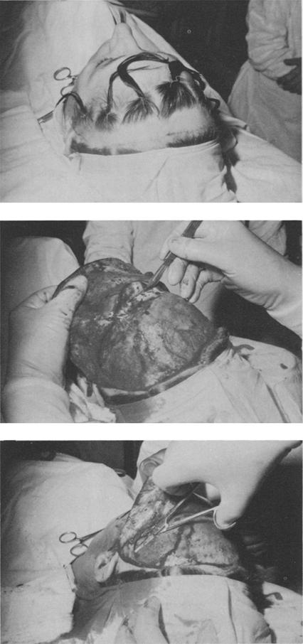 252 H. Marino Fig, 1, Tracing of the coronal incision. The shaved area of the scalp is partially or totally removed at the end of the operation Fig. 2.