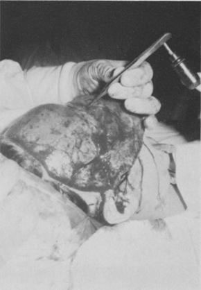 The Forehead Lift 255 Fig. 7. The corrugator fibers are selectively coagulated. Fig. 8. A measured strip of scalp is resected.