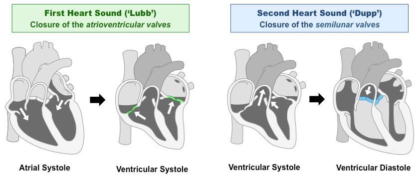 YOUR HEART BEAT Normal heart sounds are caused by one-way valves closing First sound ( Lubb )
