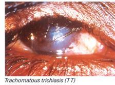 Trichiasis Caused by infection with a bacterium, Chlamydia trachomatis. Starts in childhood, with repeated episodes of infection.