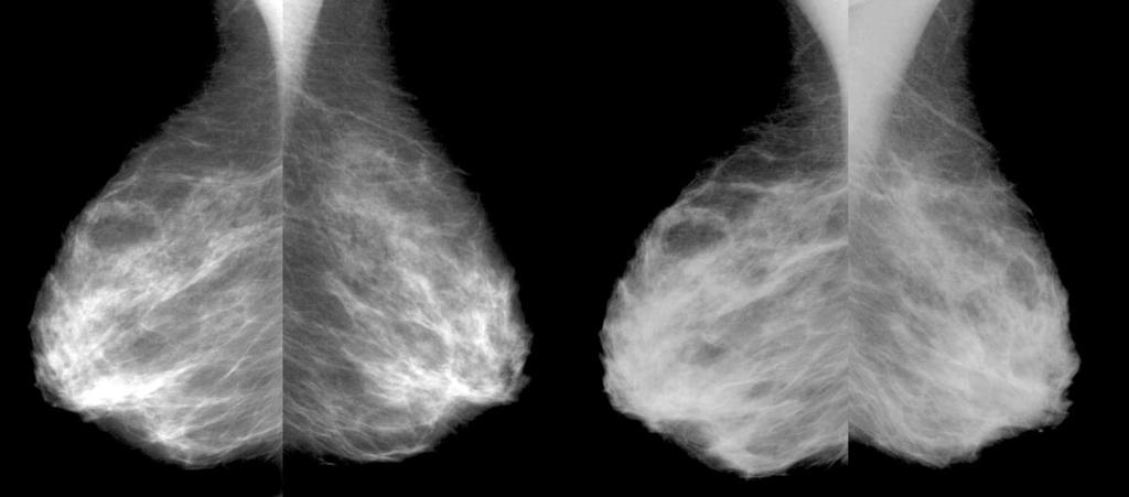 Changes in mammographic and ultrasound image of the breast of women undergoing estrogen replacement therapy 215 Fig. 1. 42-year old woman undergoing ERT (Premarin, 0.