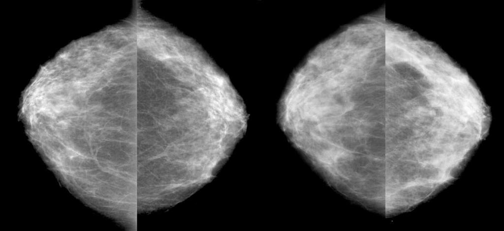 Mammograms of both breasts in oblique view, on the right after undergoing ERT for two years. Diffuse increase in breast density (1 st degree).
