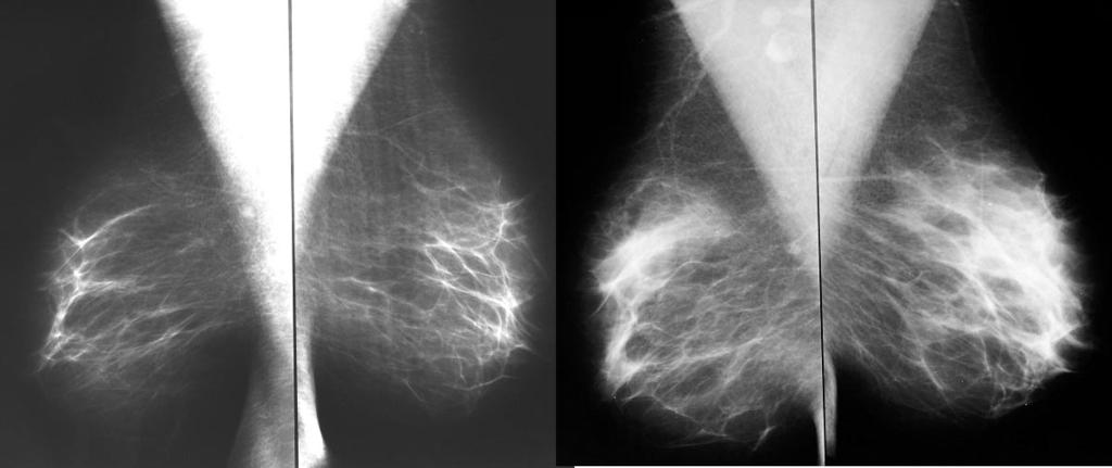 Changes in mammographic and ultrasound image of the breast of women undergoing estrogen replacement therapy 217 Fig. 5.