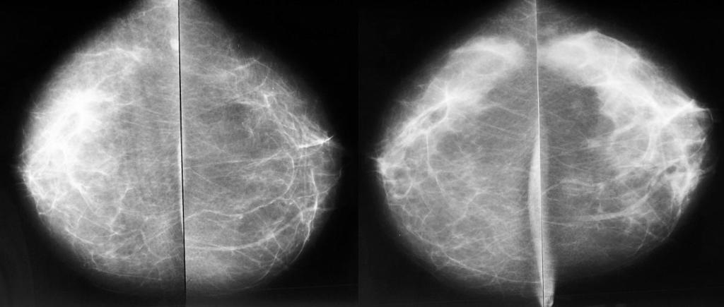 Mammograms of both breasts in oblique view- on the left before undergoing ERT and on the right after two years of ERT use.
