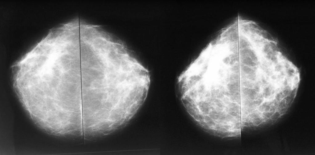 Mammographic images of both breasts in mediolateral view.