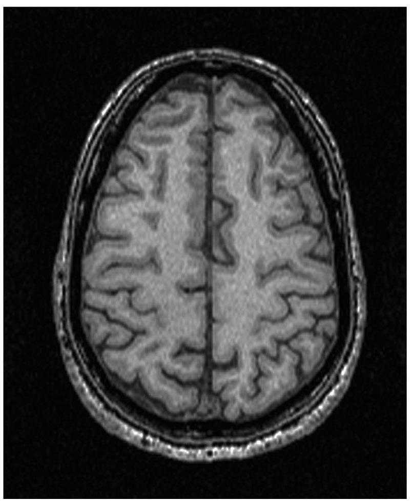 Fig. 3. Axial image through the forebrain acquired with T1-weighted MR imaging (anterior is toward the top). The red arrows identify the central sulcus.