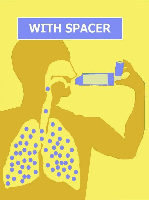 called a puffer or asthma pump). A spacer is a tool that makes your inhaler work better.