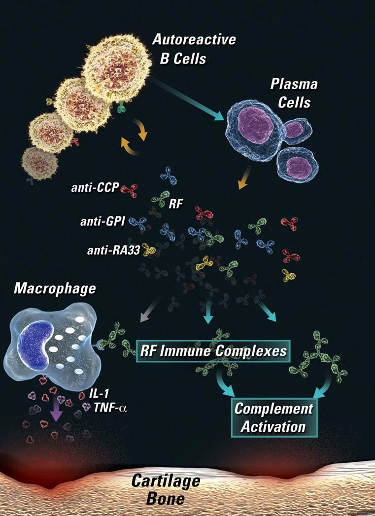 Role of B cells in RA: (2) autoantibody production Autoreactive B cells produce autoantibodies, including Rheumatoid Factor (RF) Formation of RF immune complexes in the