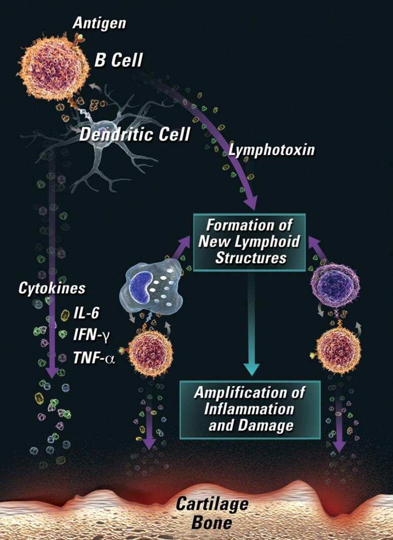 Role of B cells in RA: (3) cytokine production Activated B cells produce cytokines (e.g.