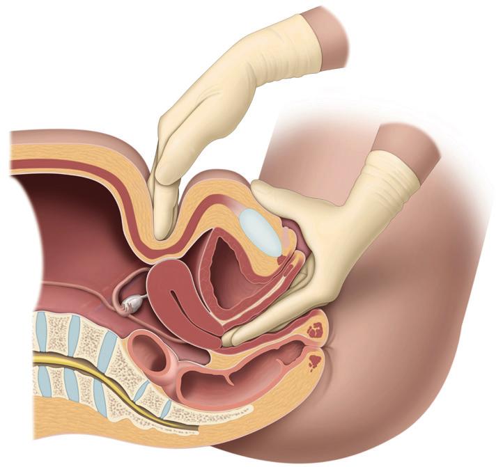 and recurrent urinary tract infections If you are female, your doctor will perform a careful examination of your external genital tract and a bimanual examination (Fig.
