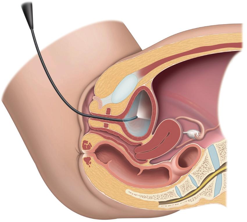 Cystoscope Vaginal canal Bladder Uterus CT urography is non-invasive, so no instruments are inserted into your body. For this examination, your kidneys must function adequately.